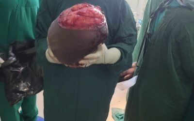 HOSPITAL CENTRAL DA BEIRA REPORTA PRIMEIRO CASO DE SUCESSO NA REMOÇÃO DE TUMOR GIGANTE NO PESCOÇO