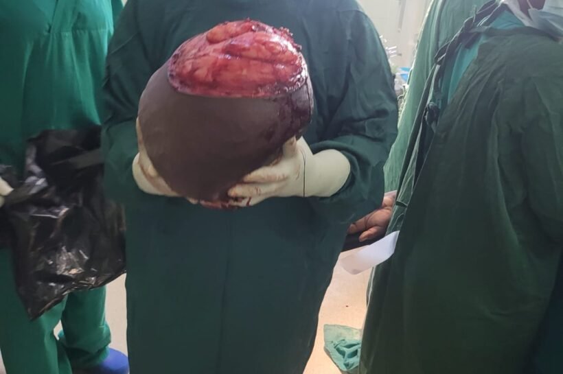 HOSPITAL CENTRAL DA BEIRA REPORTA PRIMEIRO CASO DE SUCESSO NA REMOÇÃO DE TUMOR GIGANTE NO PESCOÇO